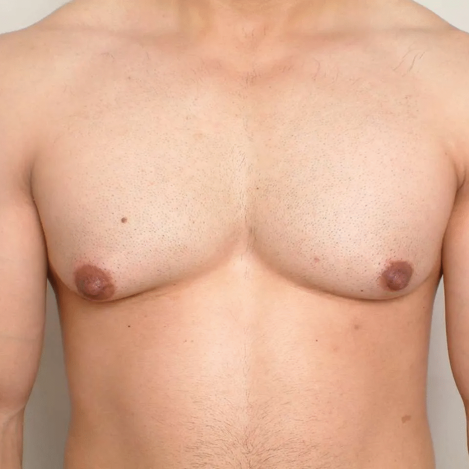 Τι είναι η γυναικομαστία