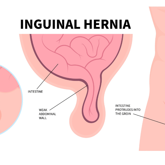 Στραγγαλισμός της Βουβωνοκήλης