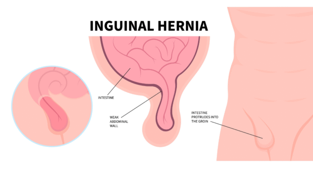 Στραγγαλισμός της Βουβωνοκήλης