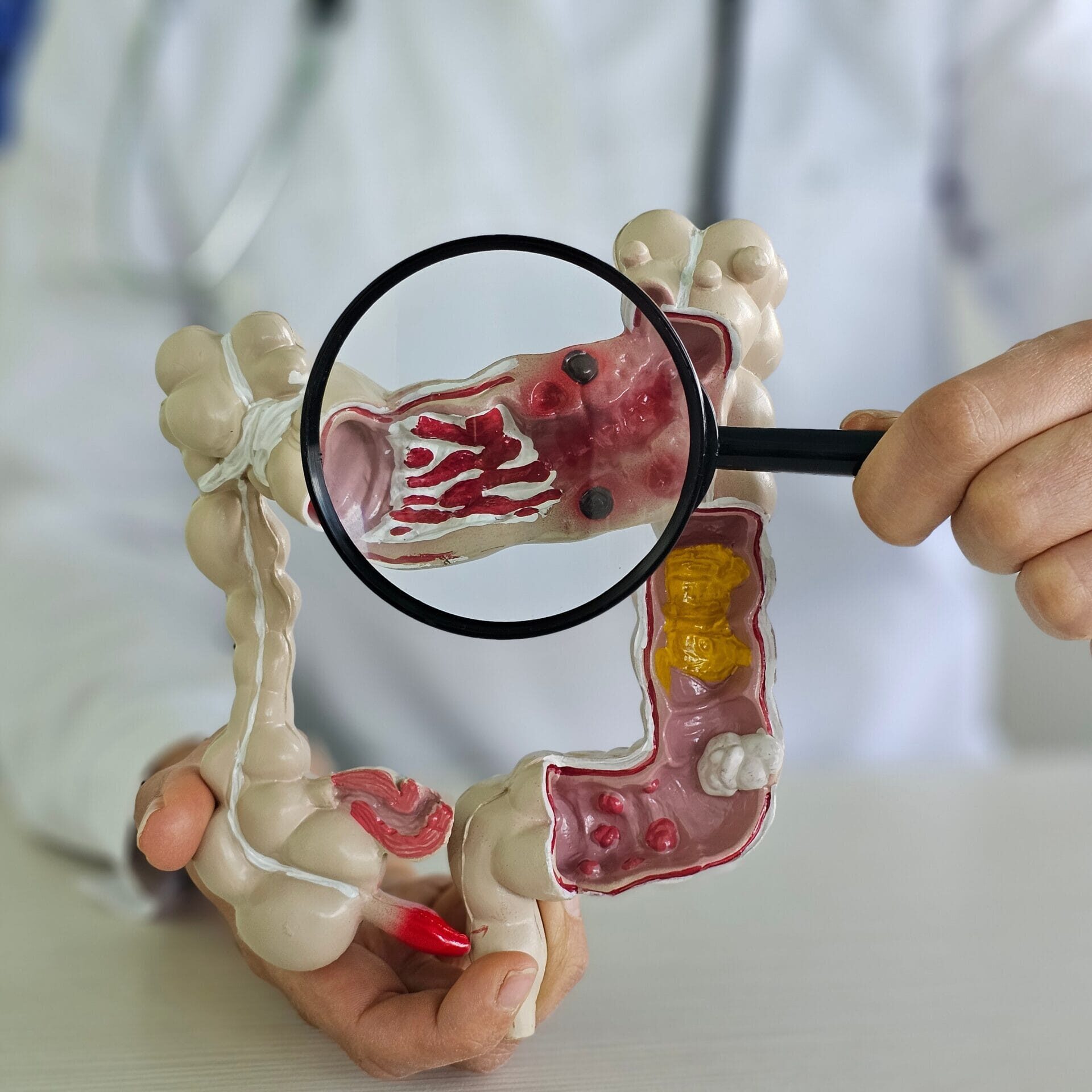 Τι είναι η Ελκώδης Κολίτιδα