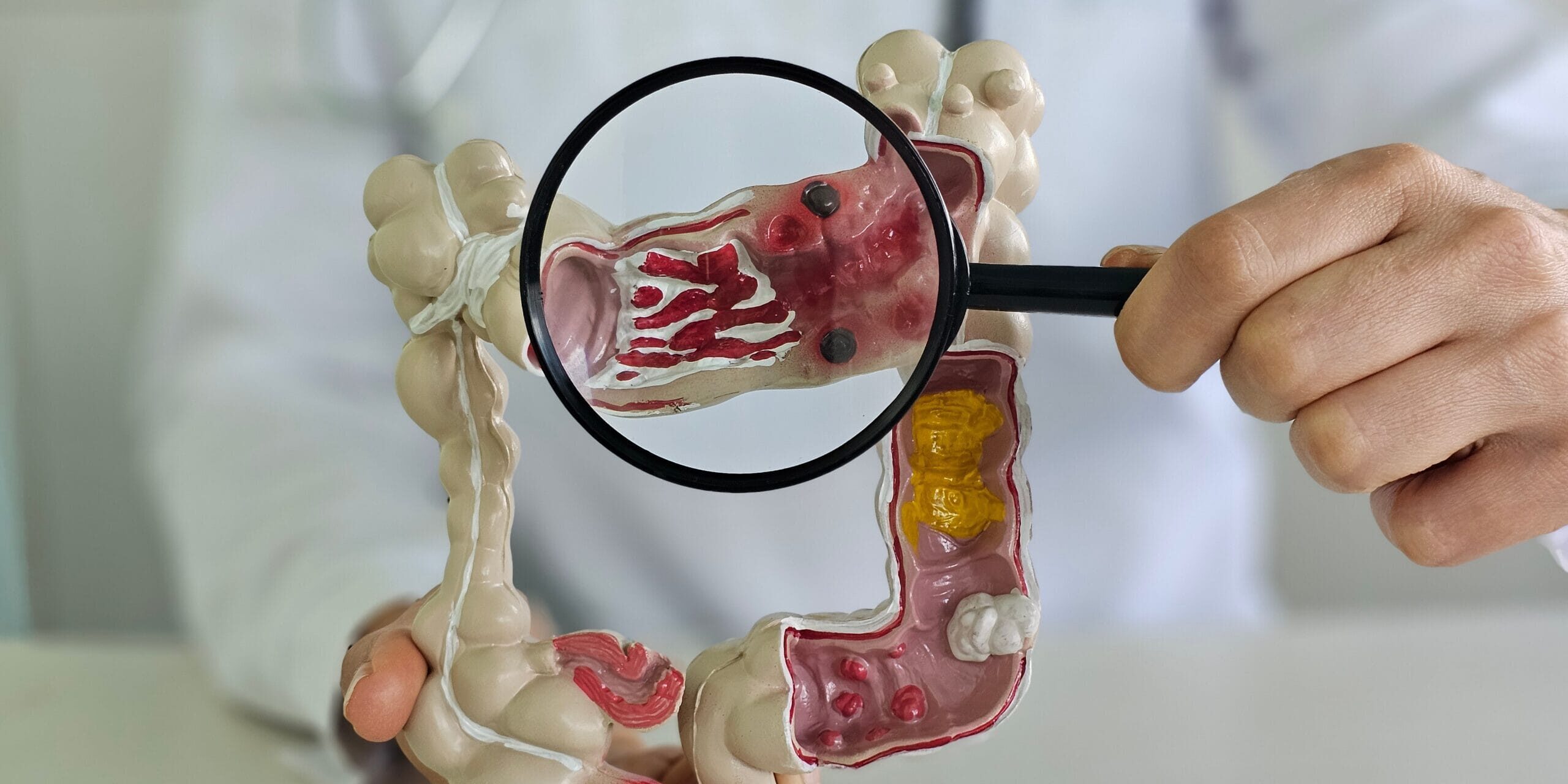 Τι είναι η Ελκώδης Κολίτιδα