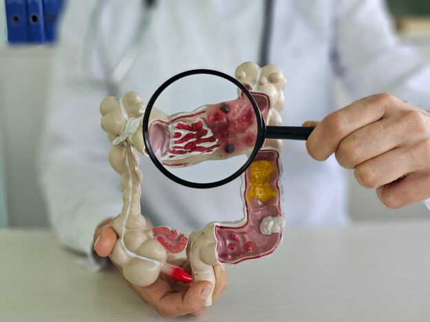 Τι είναι η Ελκώδης Κολίτιδα