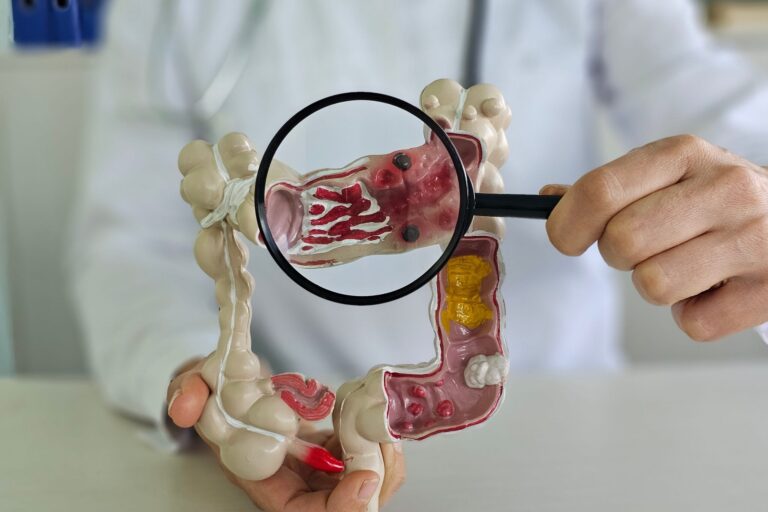 Τι είναι η Ελκώδης Κολίτιδα Τι είναι η Ελκώδης Κολίτιδα