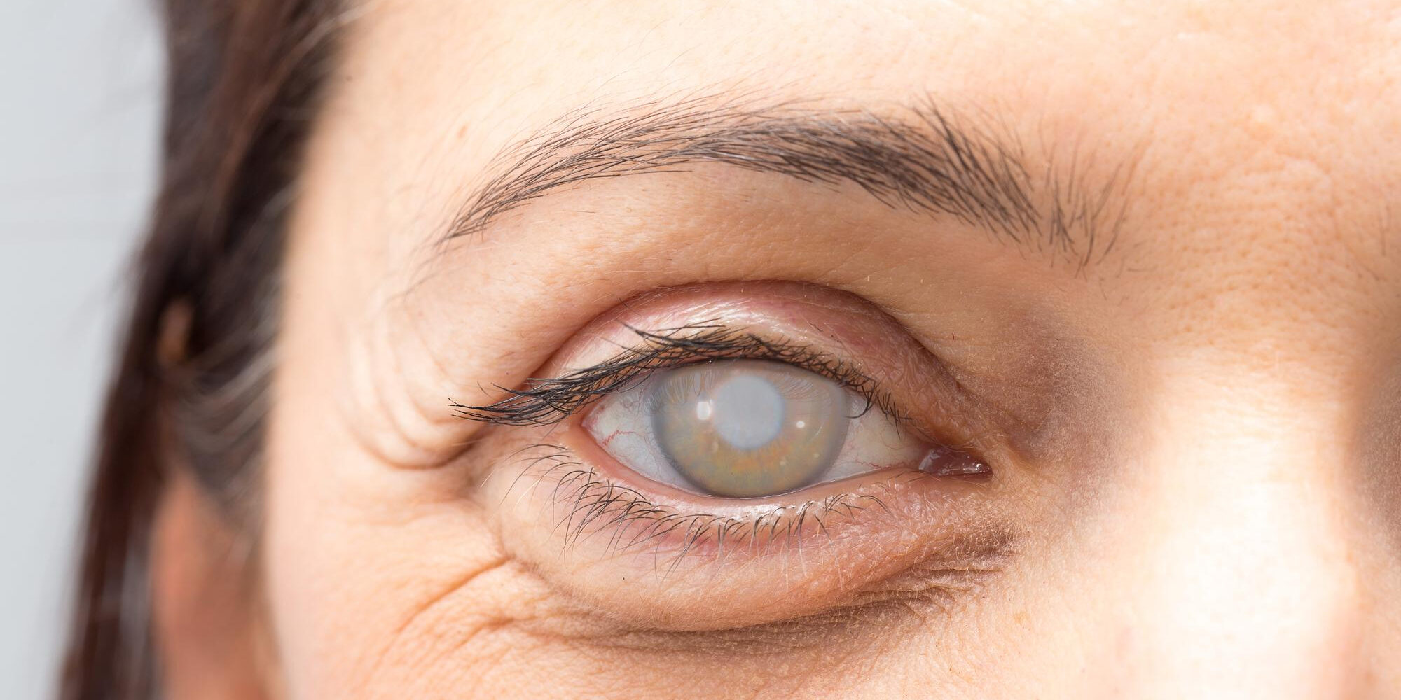 Τι είναι ο καταρράκτης