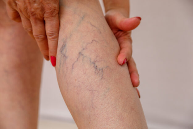 Τι είναι οι ευρυαγγείες