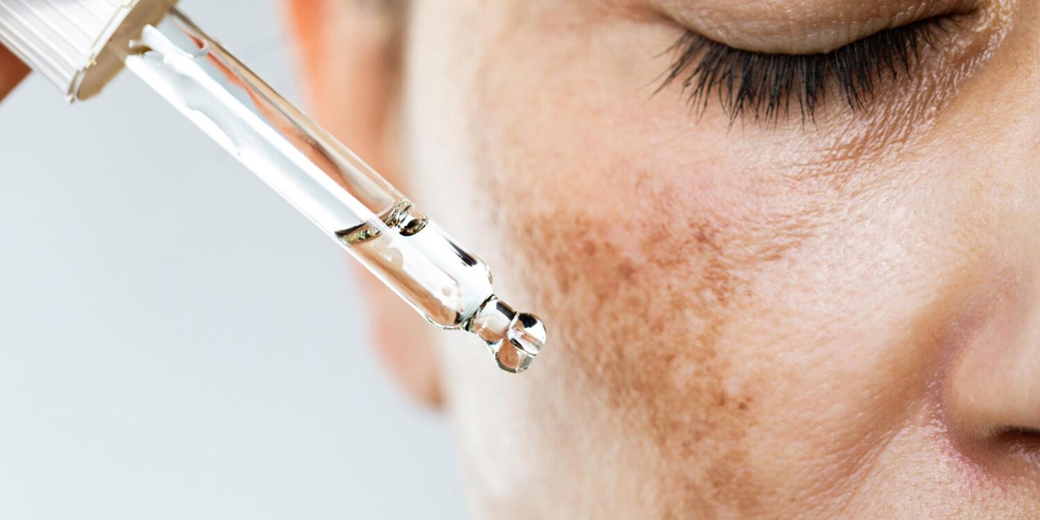 πανάδες στο πρόσωπο πώς φεύγουν πανάδες στο πρόσωπο πώς φεύγουν