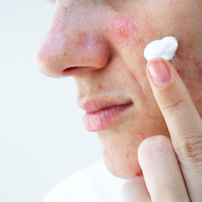 σπυράκια με πύον στο πρόσωπο