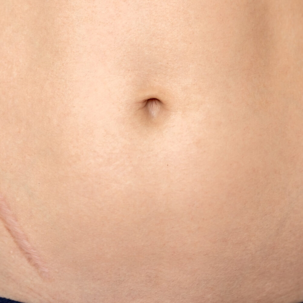 καλύτερη αναπλαστική κρέμα για ουλές