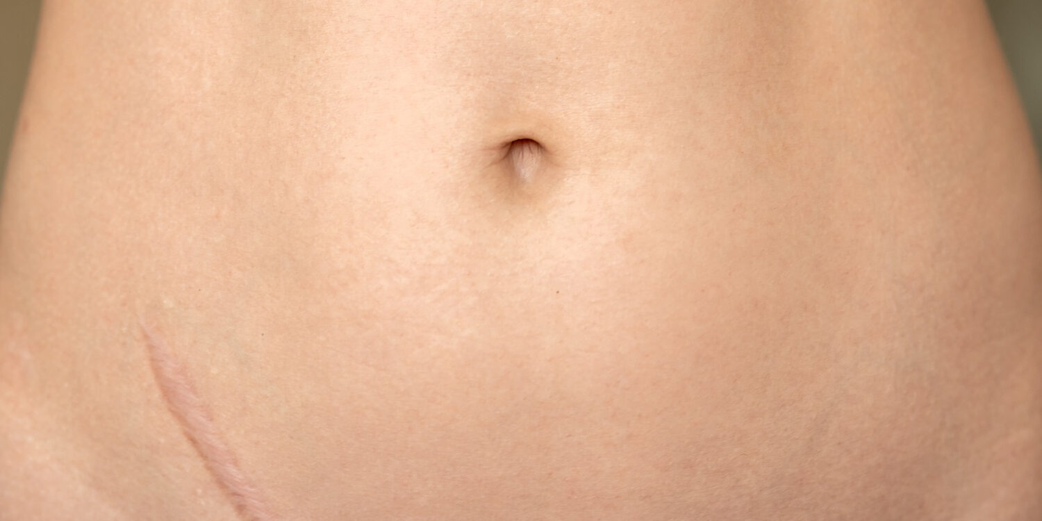 ποια είναι η καλύτερη αναπλαστική κρέμα για ουλές