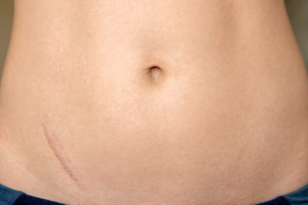 ποια είναι η καλύτερη αναπλαστική κρέμα για ουλές