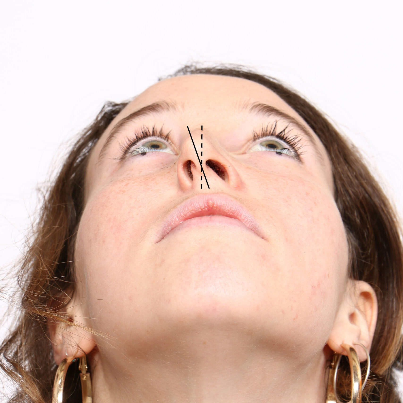 apotiximeni vlefaroplastiki