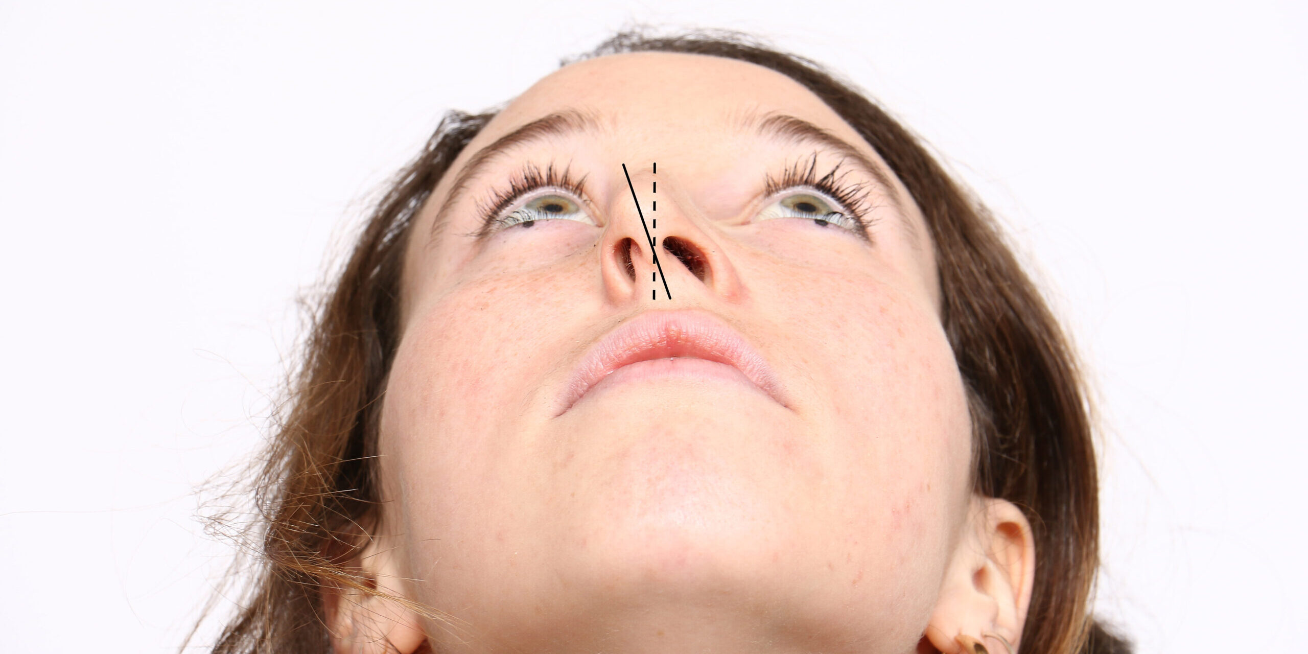 apotiximeni vlefaroplastiki