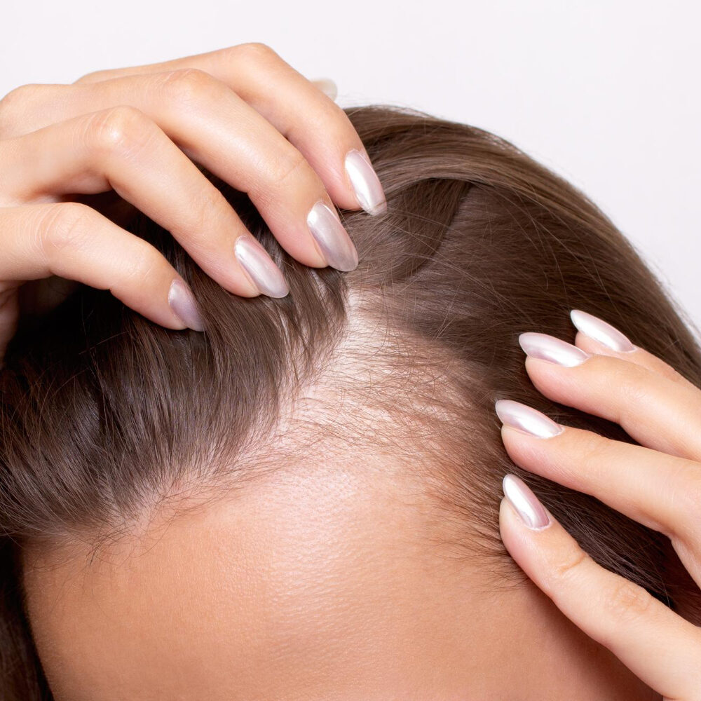 τριχόπτωση