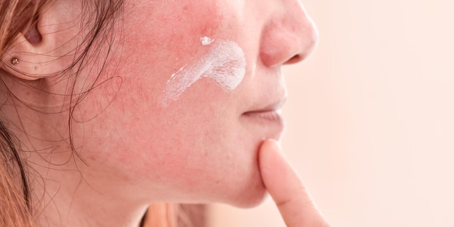 δερματίτιδα στο πρόσωπο