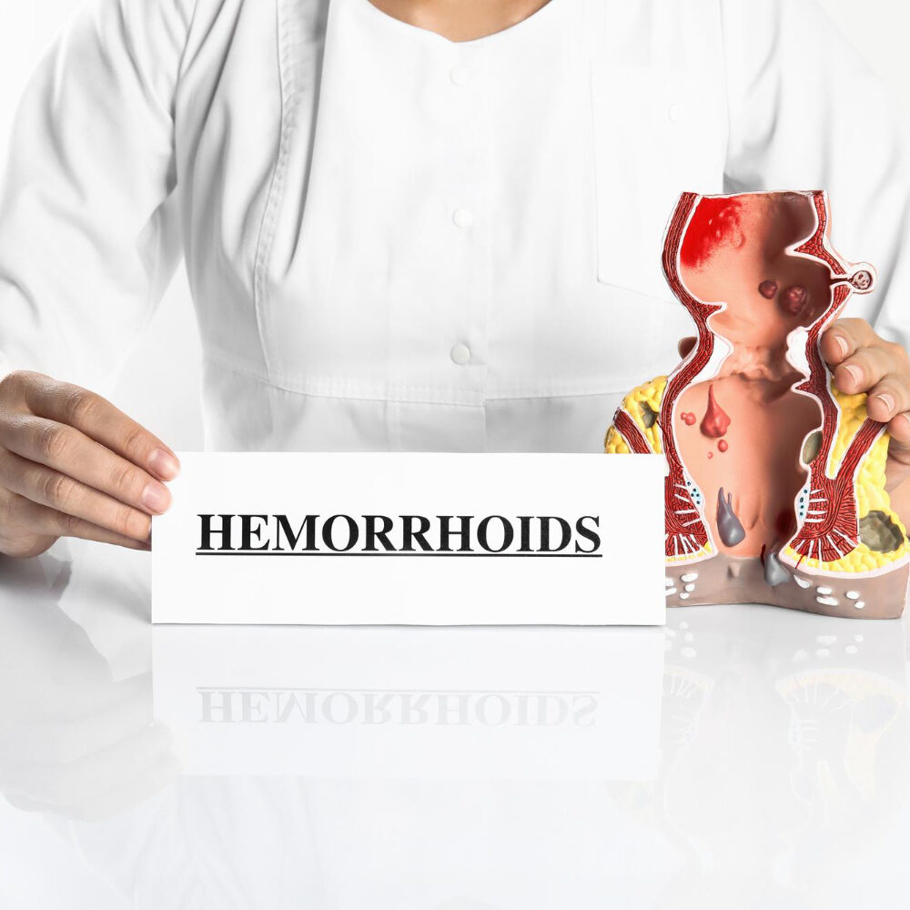Η γρήγορη λύση για τις αιμορροΐδες