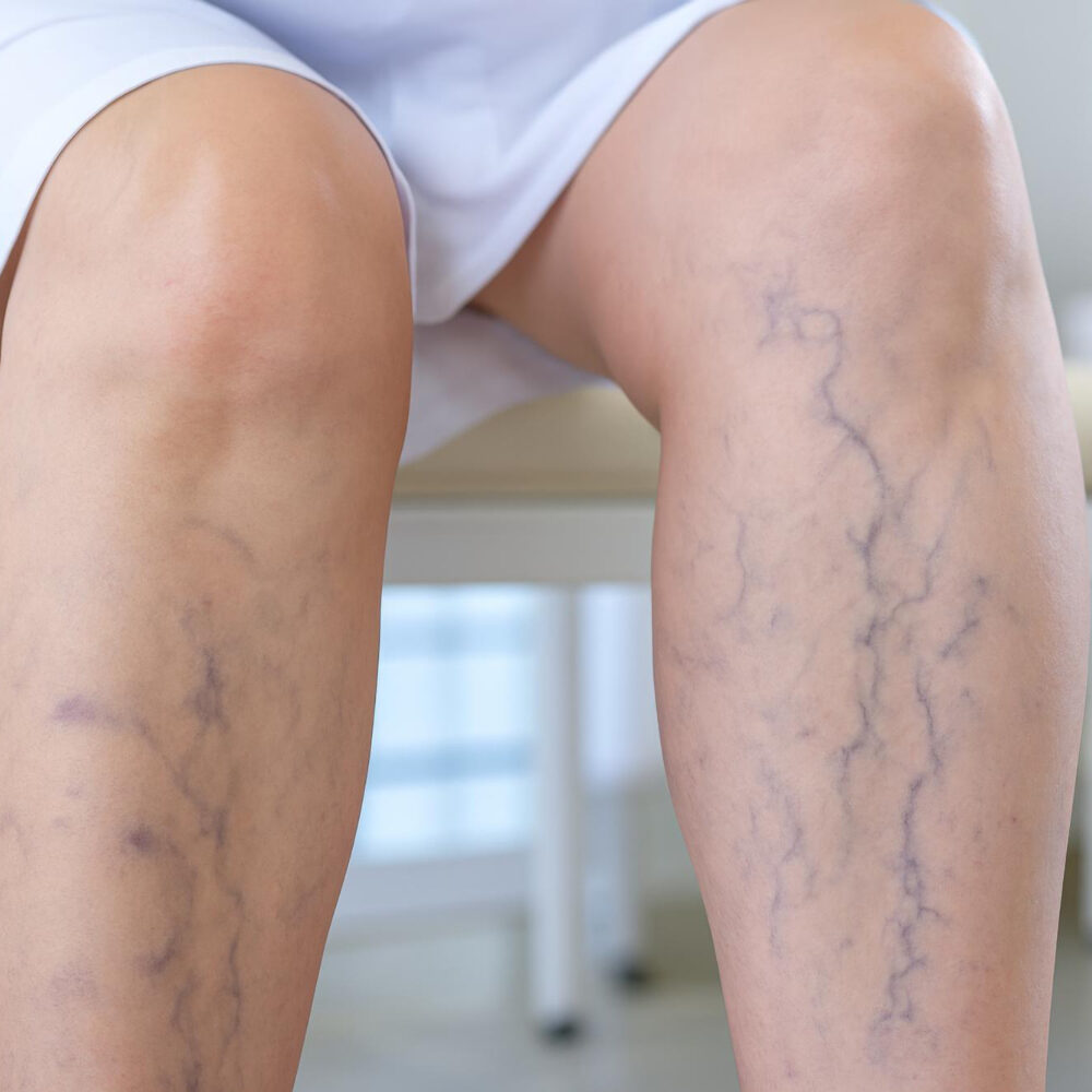 Θρόμβωση και κιρσοί