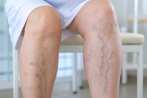 Θρόμβωση και κιρσοί