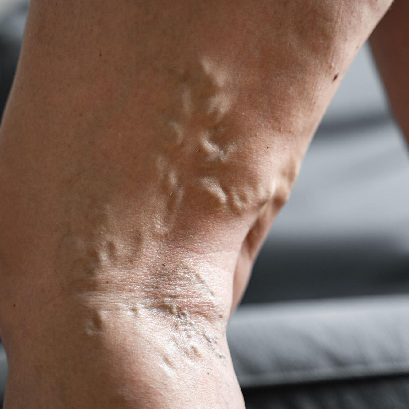 κιρσοι σε δημοσιο νοσοκομειο