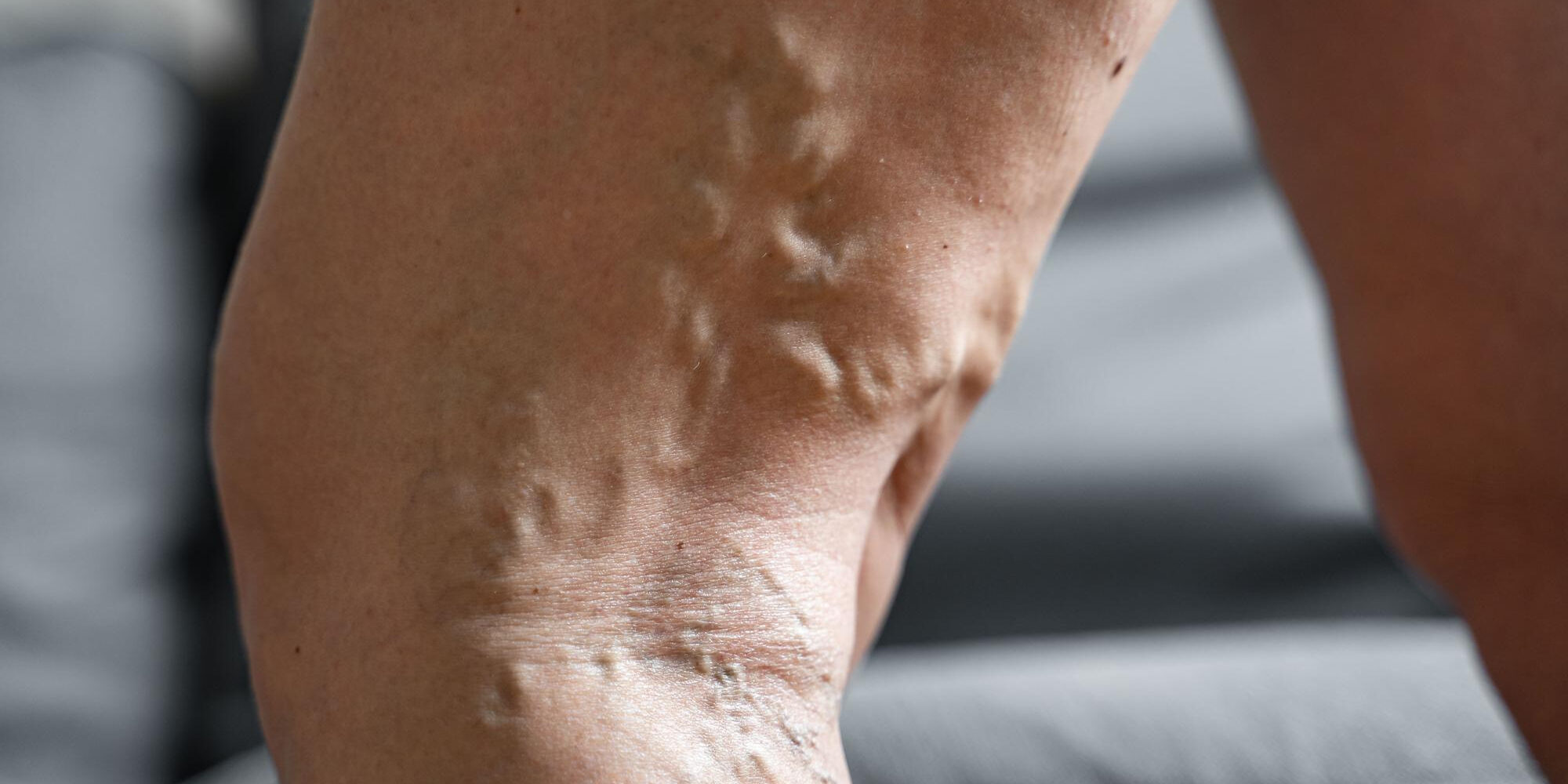 κιρσοι σε δημοσιο νοσοκομειο