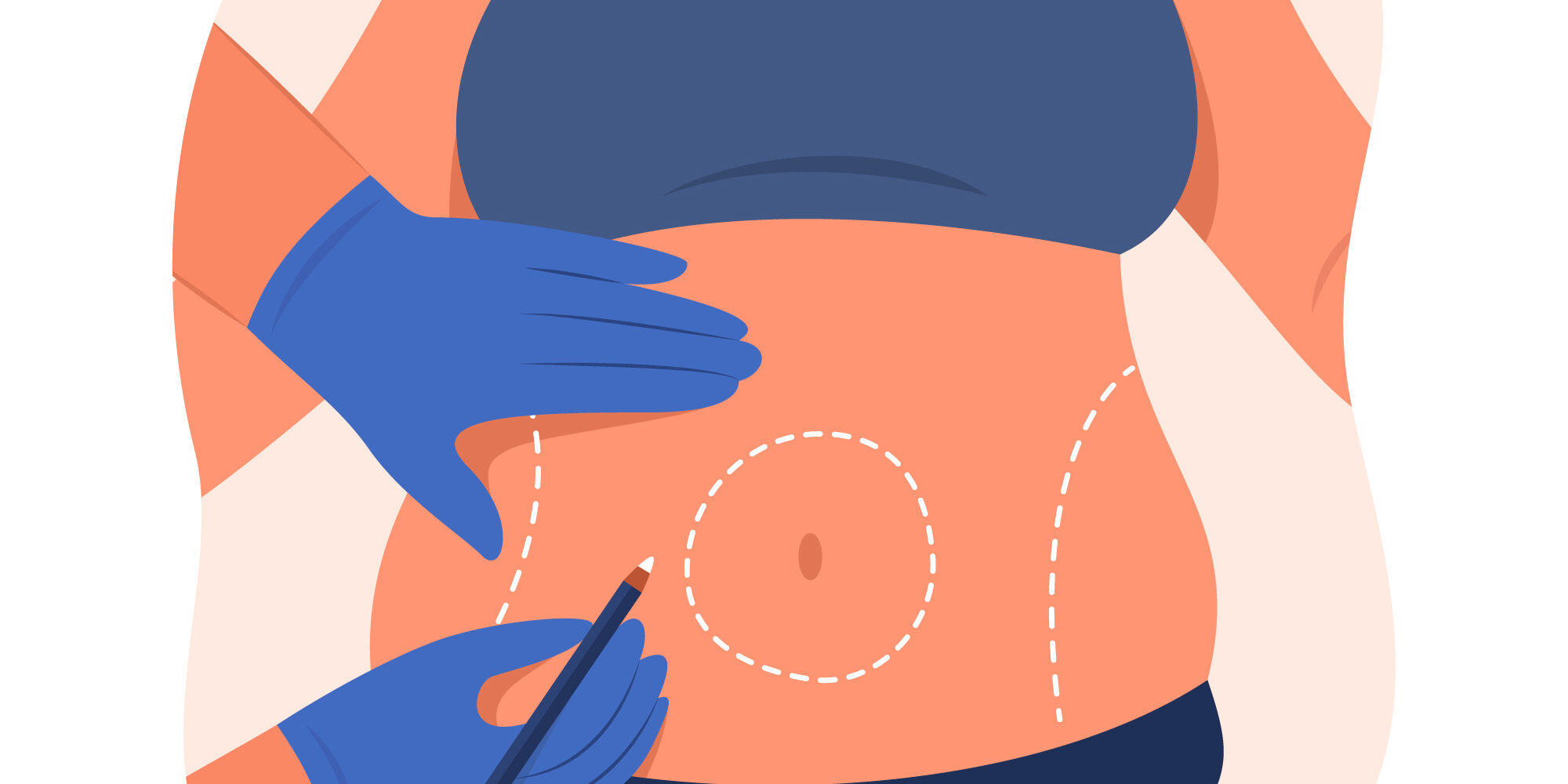 Καλύτερος Πλαστικός για Κοιλιοπλαστική Καλύτερος Πλαστικός για Κοιλιοπλαστική