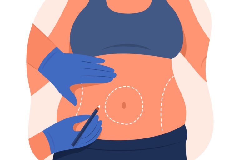 Καλύτερος Πλαστικός για Κοιλιοπλαστική Καλύτερος Πλαστικός για Κοιλιοπλαστική