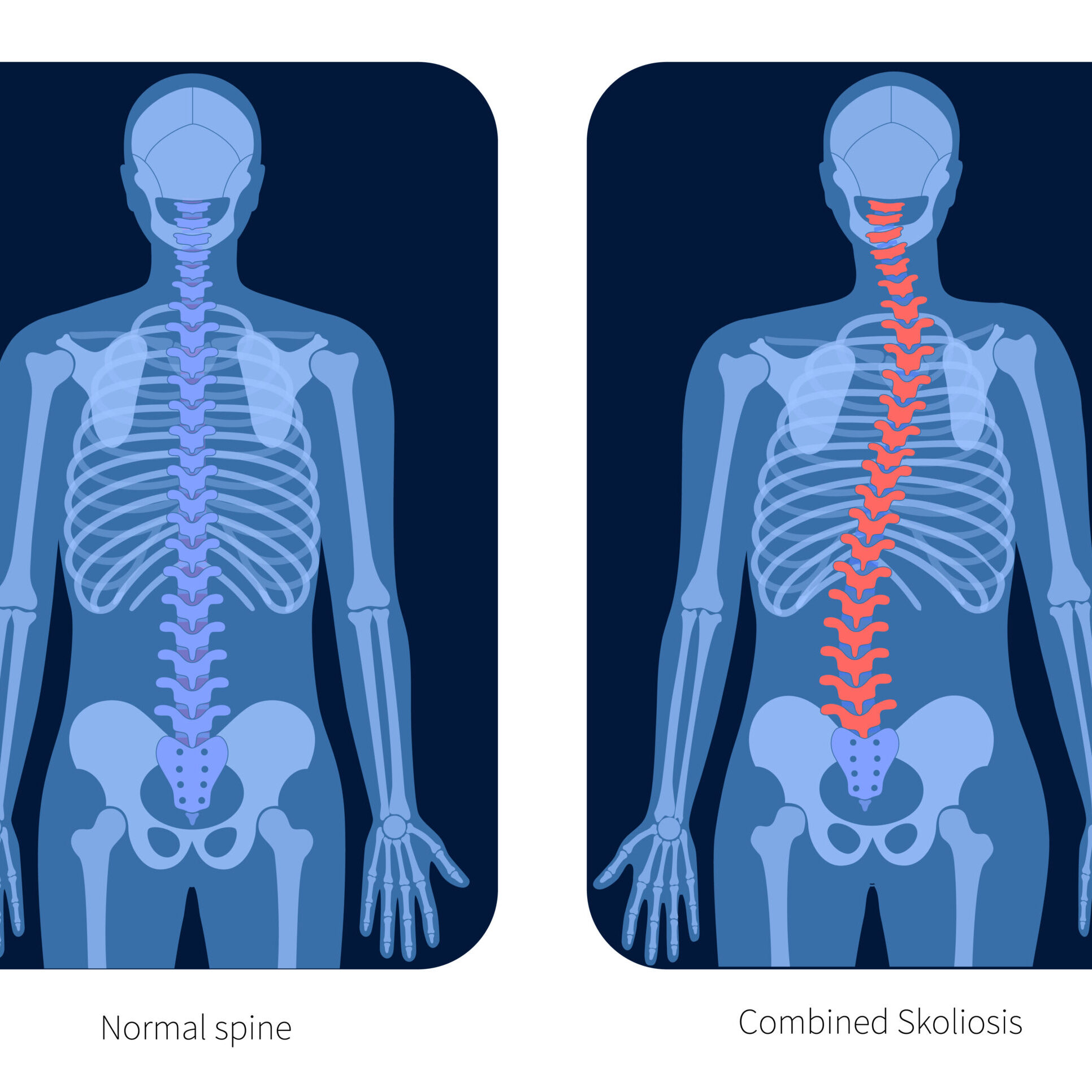 Σκολίωση Χωρίς Χειρουργείο