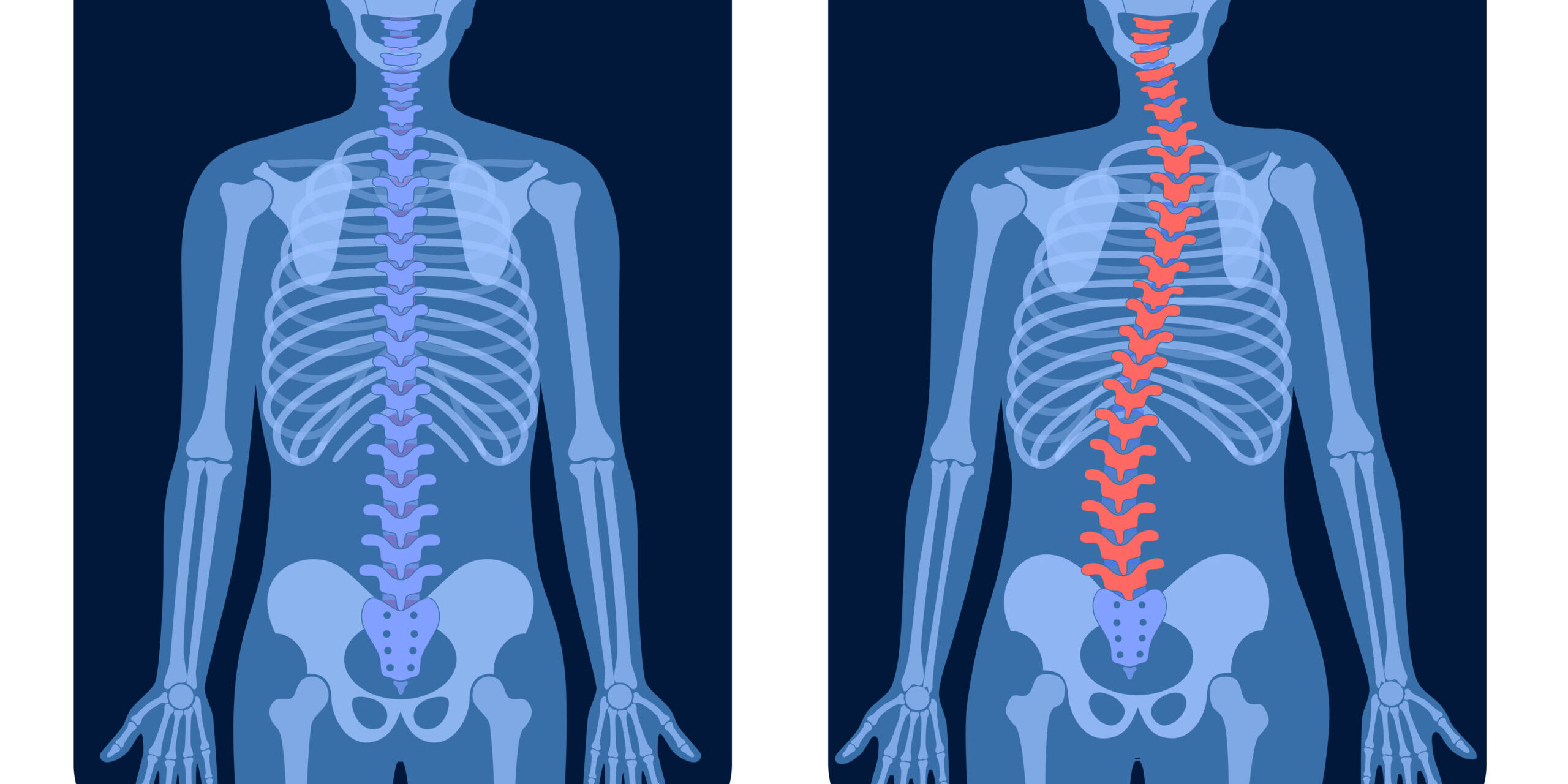 Σκολίωση Χωρίς Χειρουργείο