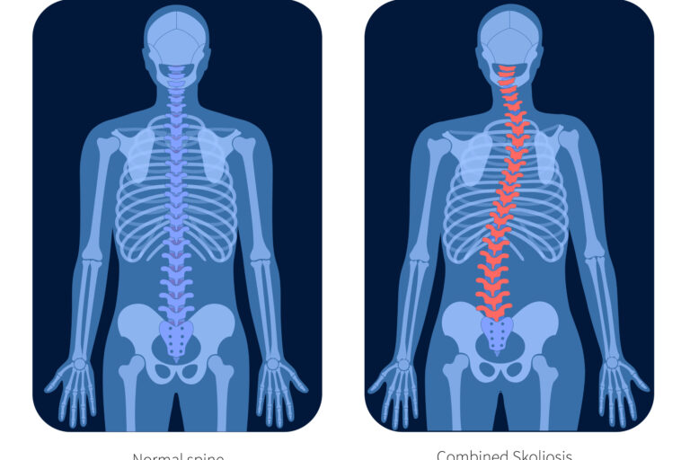 Σκολίωση Χωρίς Χειρουργείο