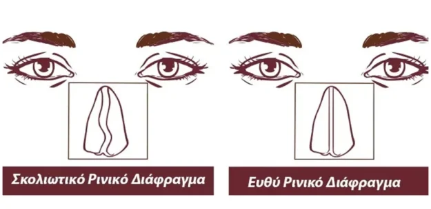 kaliteroi xeirourgoi orl gia diafragma