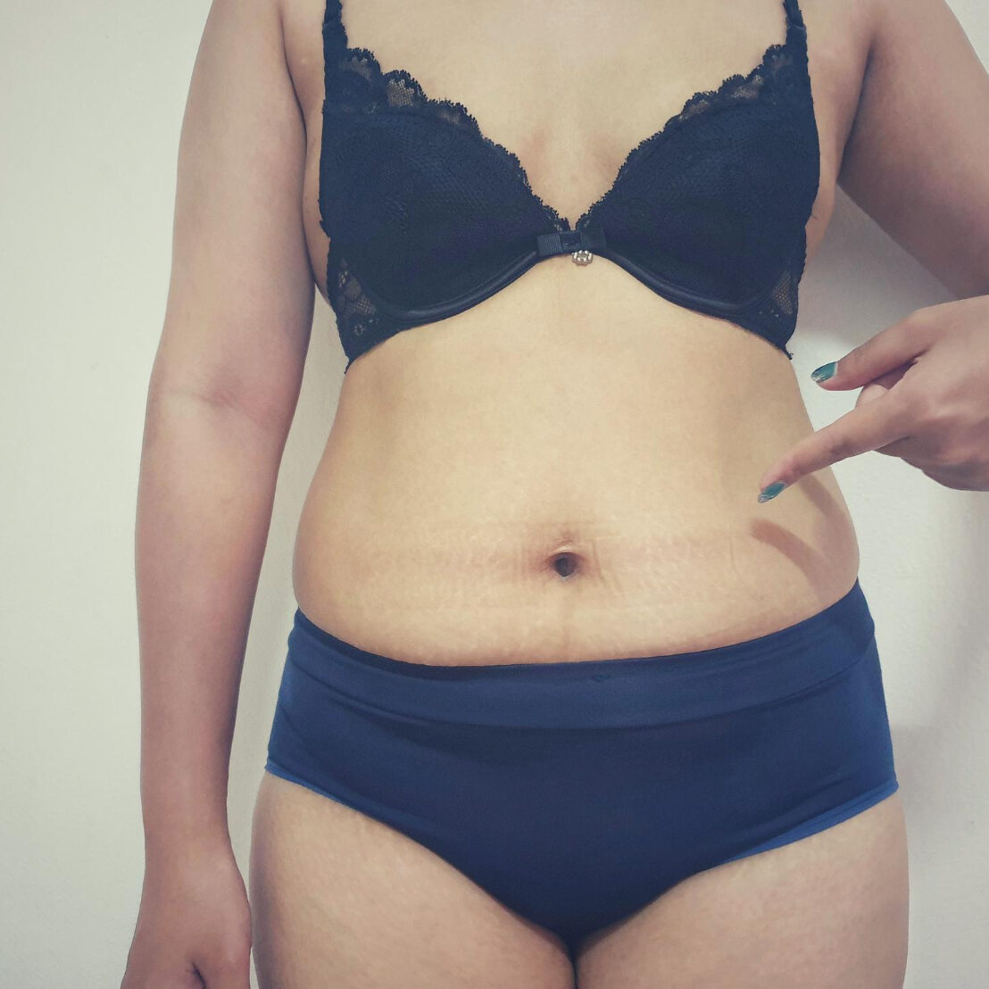 Αποτυχημένη-κοιλιοπλαστική