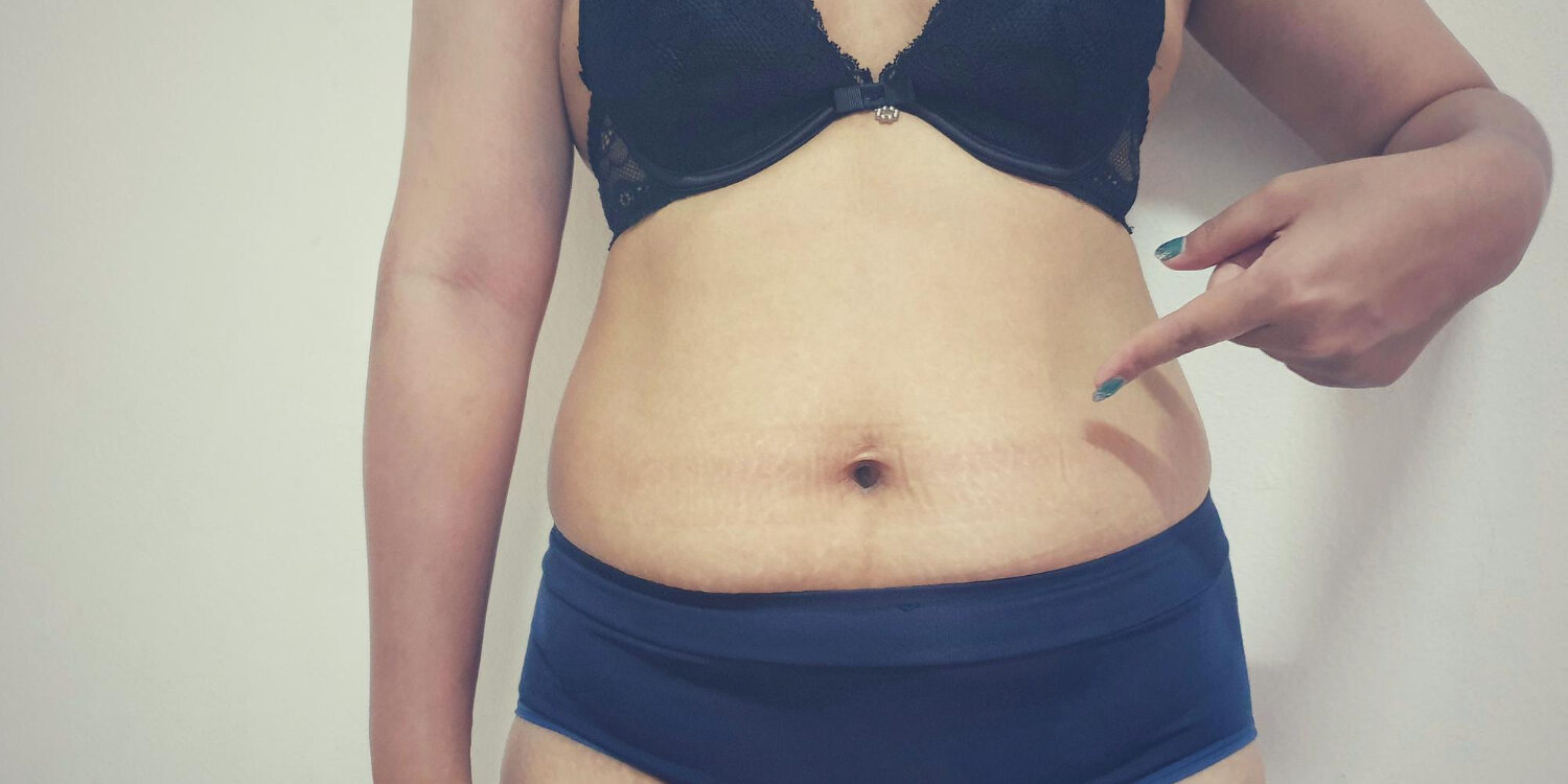 Αποτυχημένη-κοιλιοπλαστική Αποτυχημένη-κοιλιοπλαστική