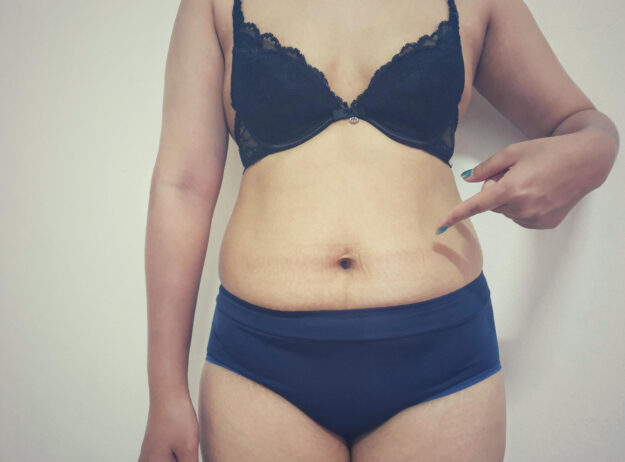 Αποτυχημένη-κοιλιοπλαστική