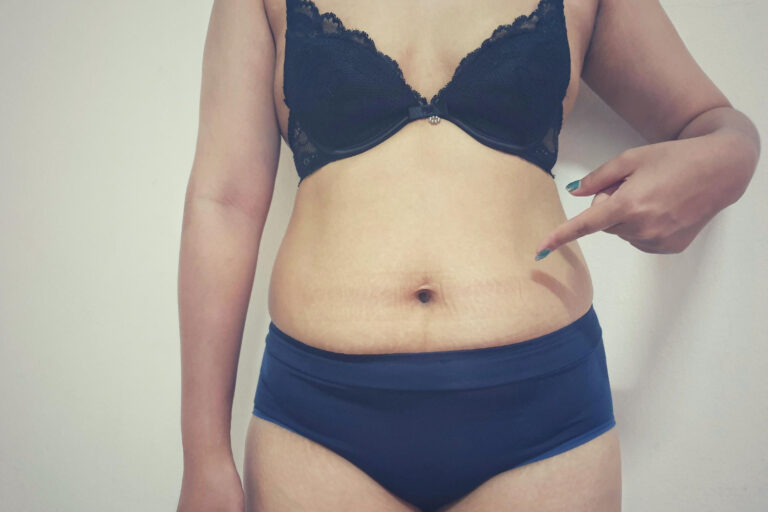 Αποτυχημένη-κοιλιοπλαστική