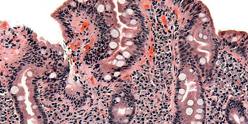 Κοιλιοκάκη