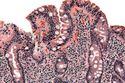 Κοιλιοκάκη