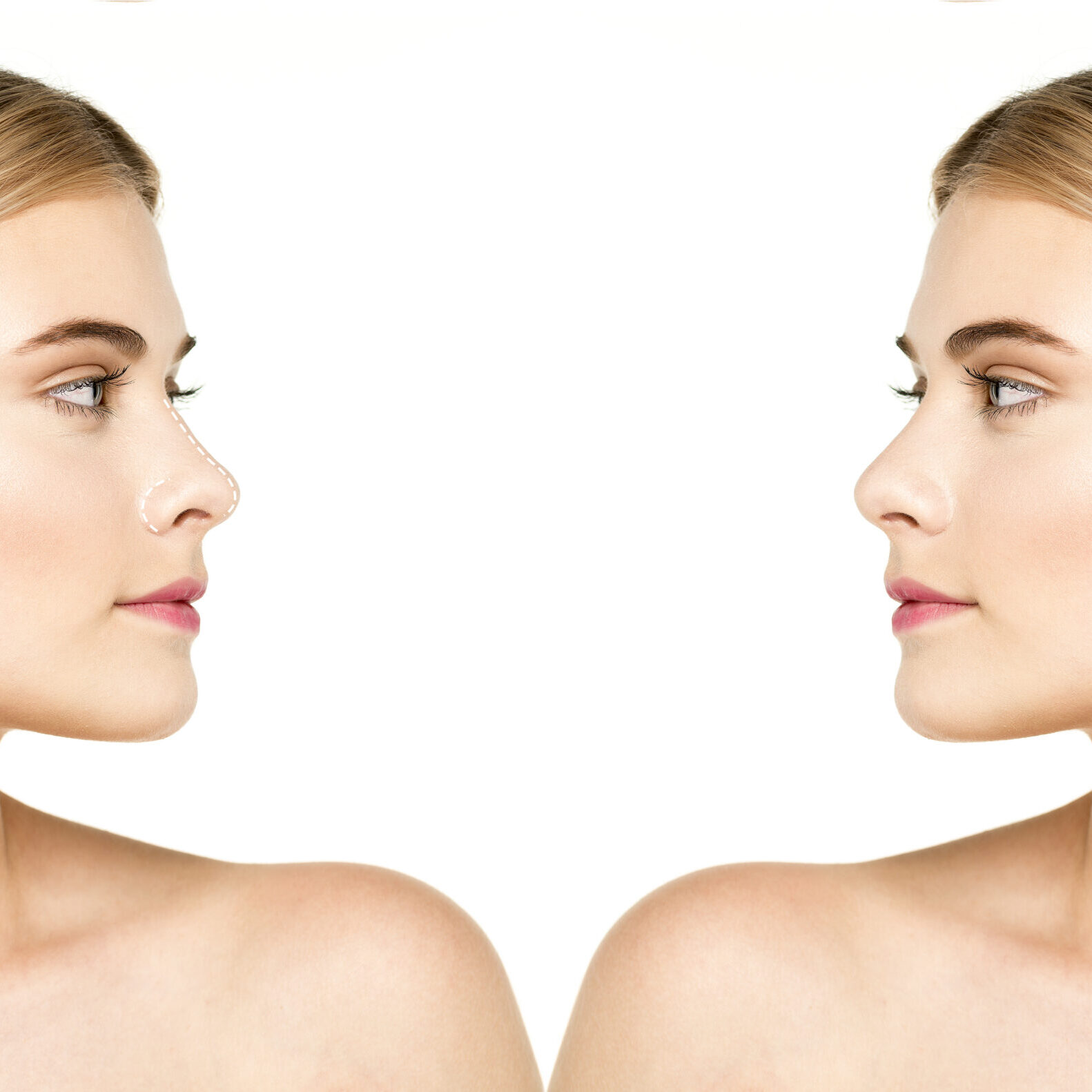 Οι 5 μεγαλύτεροι μύθοι γύρω από τη ρινοπλαστική και το στραβό διάφραγμα, Τι πραγματικά ισχύει