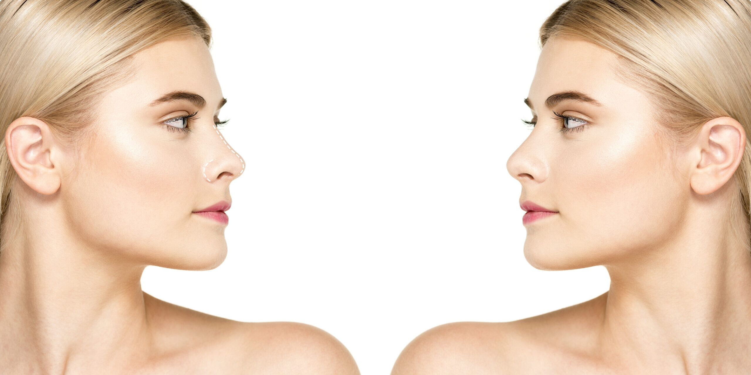 Οι 5 μεγαλύτεροι μύθοι γύρω από τη ρινοπλαστική και το στραβό διάφραγμα, Τι πραγματικά ισχύει Οι 5 μεγαλύτεροι μύθοι γύρω από τη ρινοπλαστική και το στραβό διάφραγμα, Τι πραγματικά ισχύει