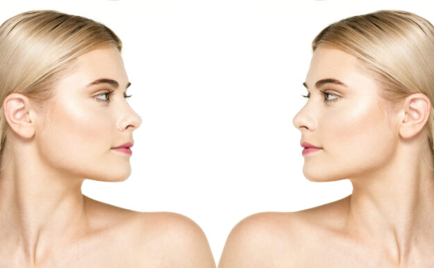 Οι 5 μεγαλύτεροι μύθοι γύρω από τη ρινοπλαστική και το στραβό διάφραγμα, Τι πραγματικά ισχύει