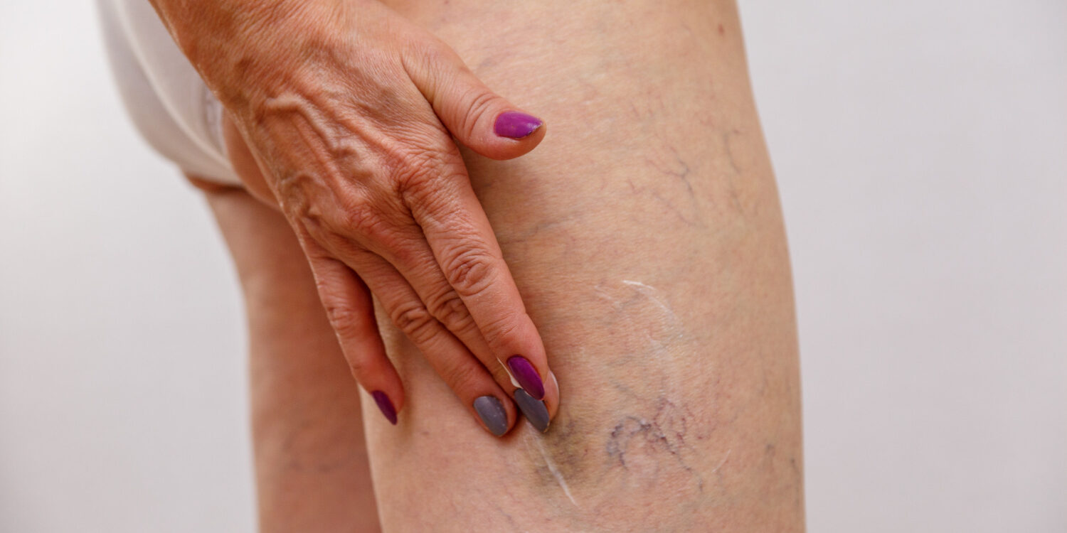 ευρυαγγείες