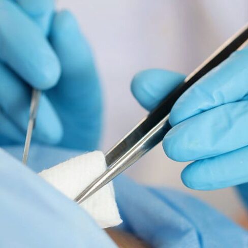 peritomi-me-laser-iatromedia