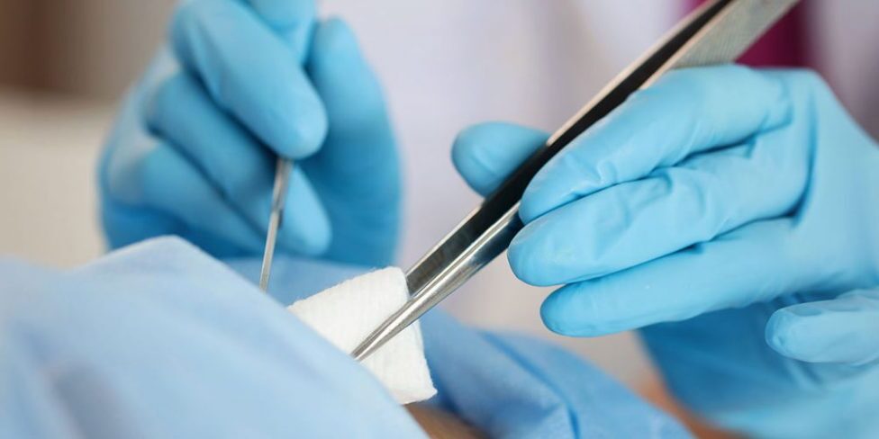 peritomi-me-laser-iatromedia