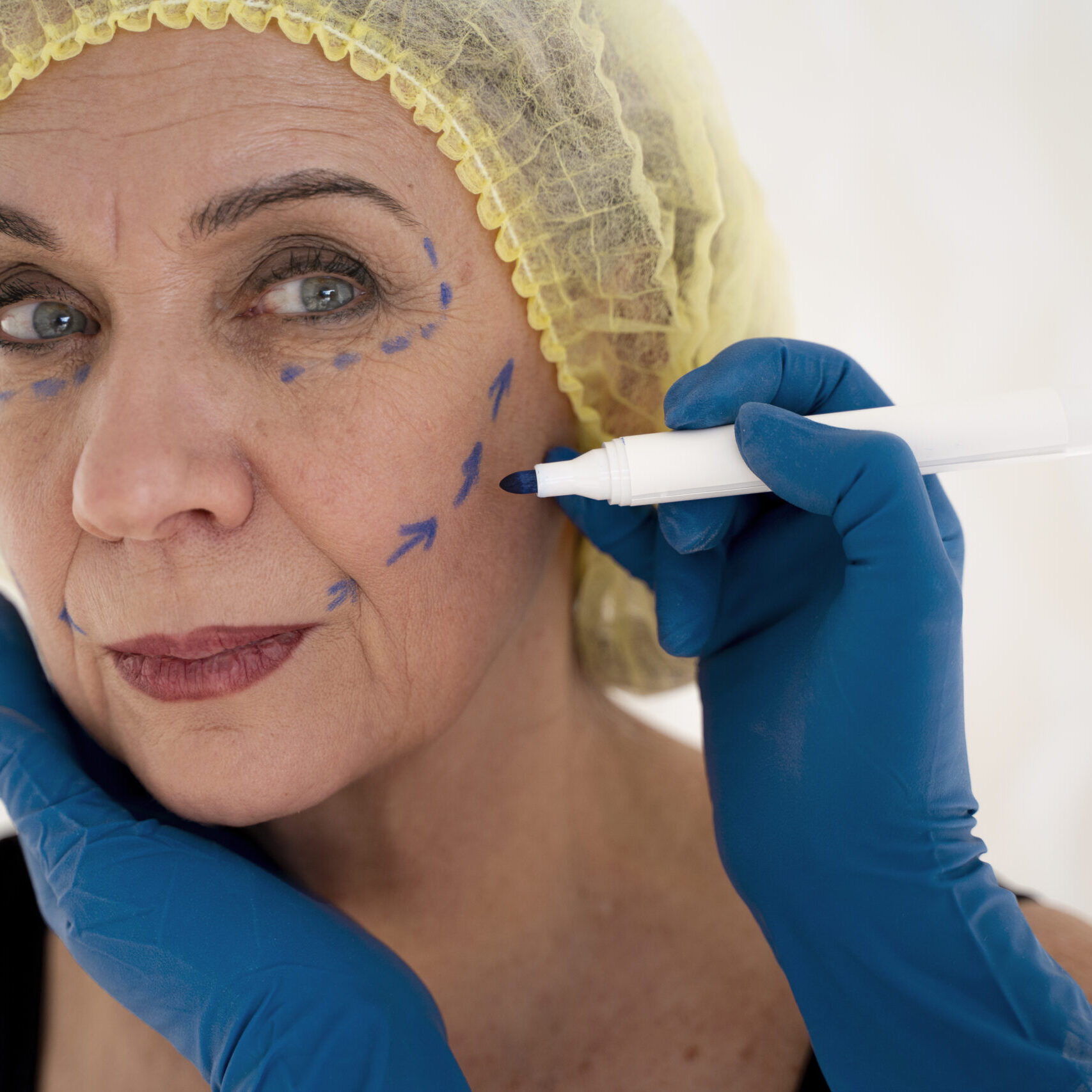 Facelift Deep Plane 2026