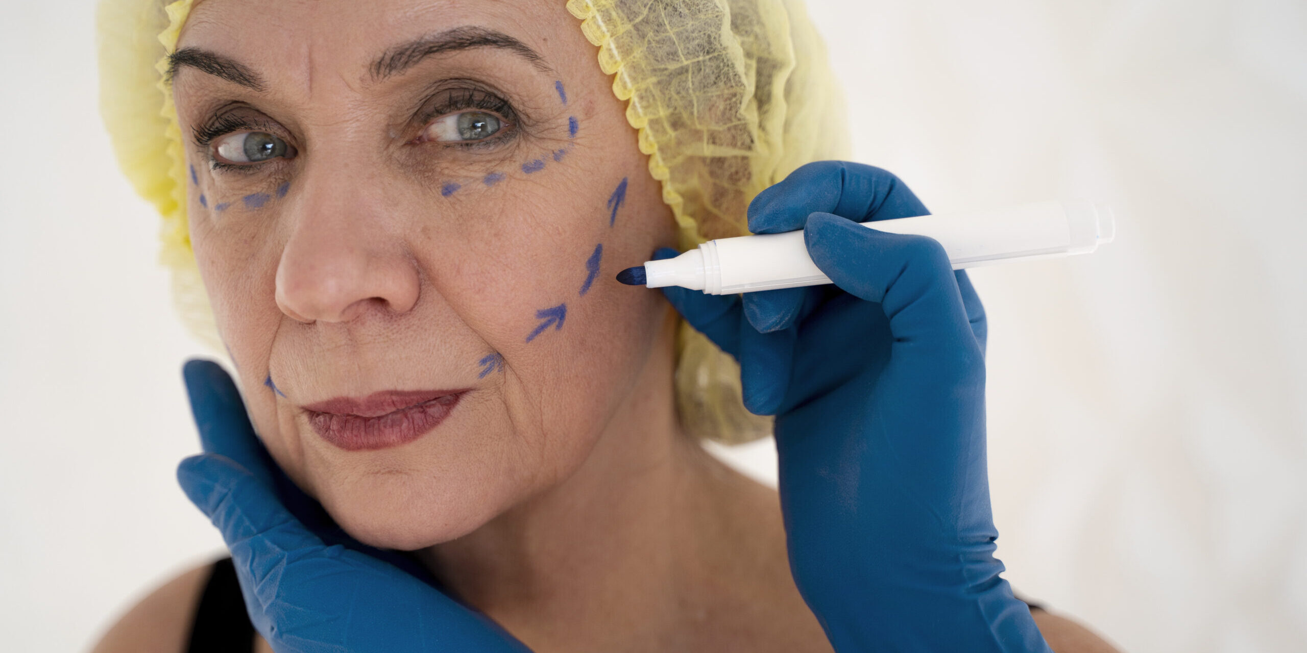 Facelift Deep Plane 2026