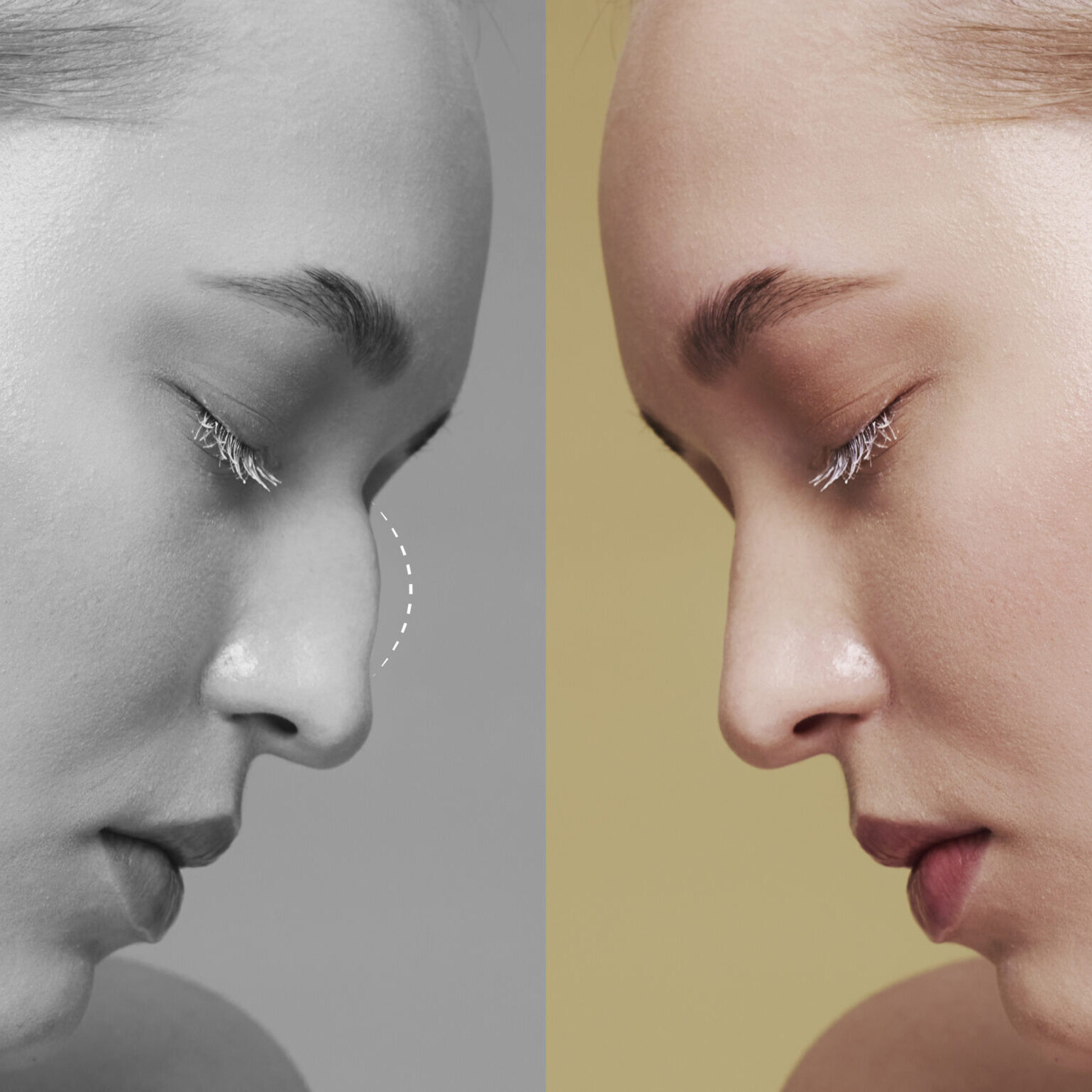 Ρινοπλαστική 2026