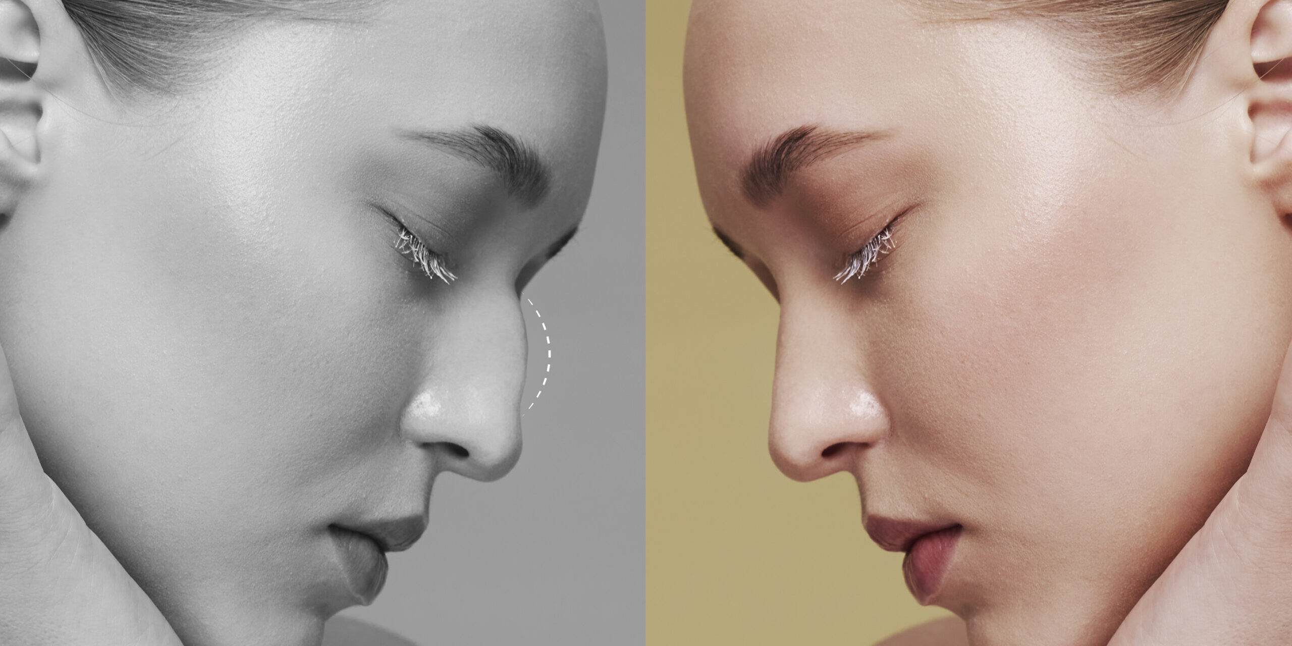 Ρινοπλαστική 2026