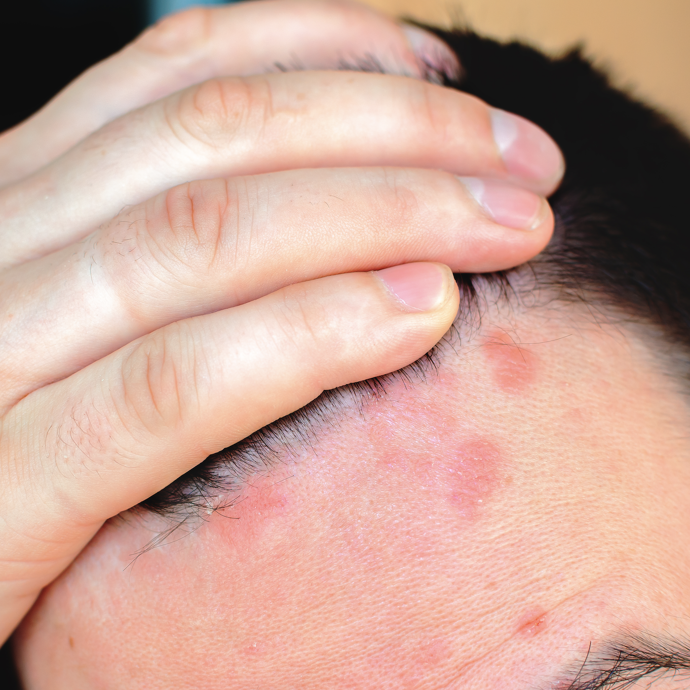 smigmatoroiiki dermatitida