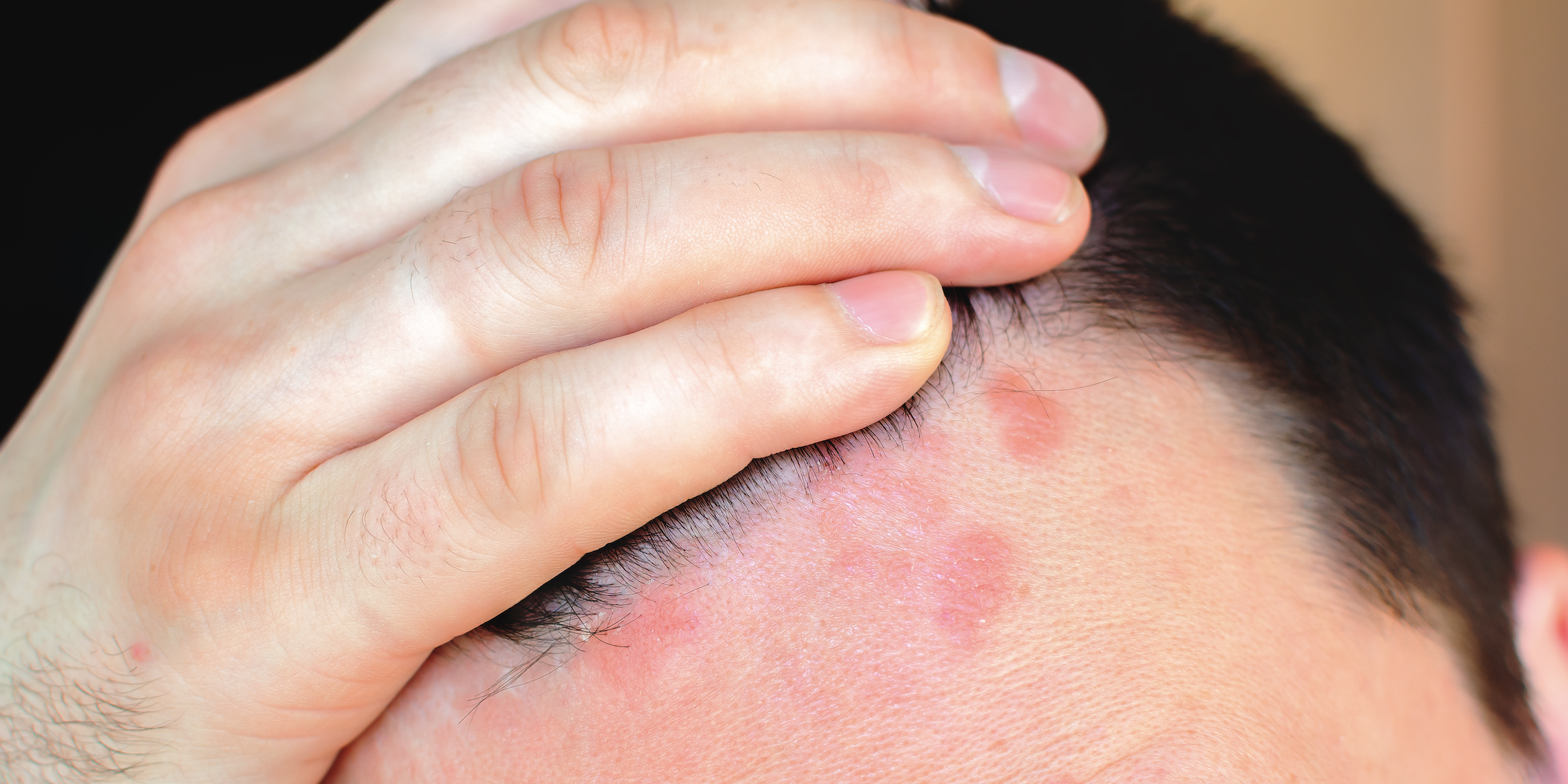 smigmatoroiiki dermatitida