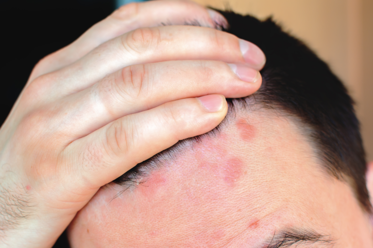 smigmatoroiiki dermatitida smigmatoroiiki dermatitida