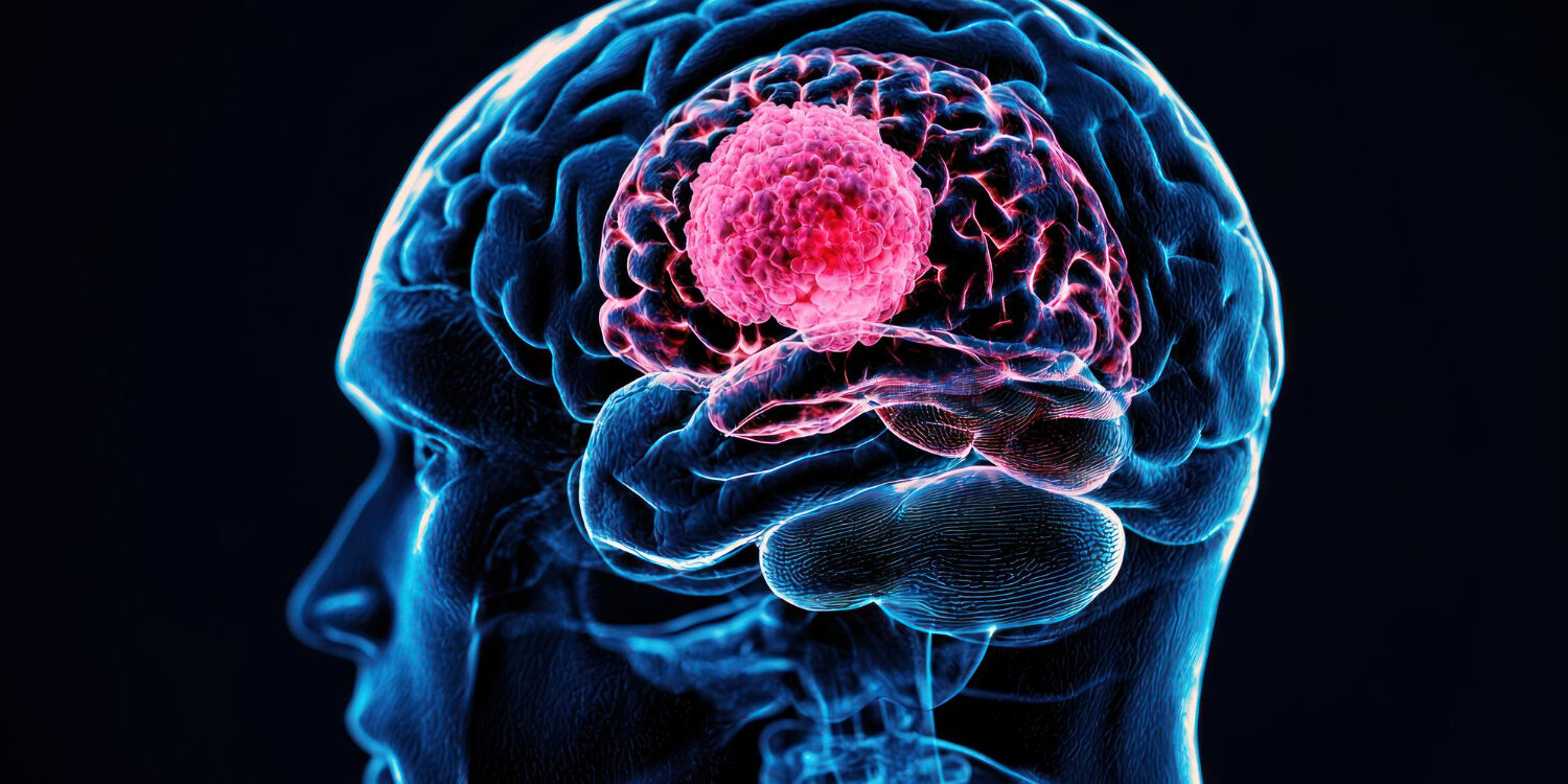 Όγκοι εγκεφάλου