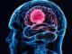 Όγκοι εγκεφάλου
